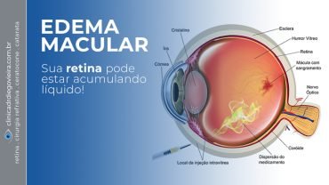 Edema Macular - Implante de Corticoide Biodegradável
