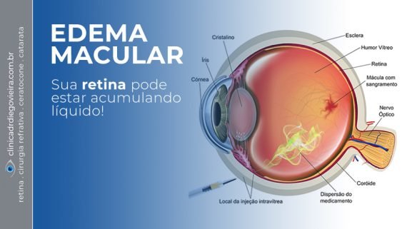 Edema Macular - Implante de Corticoide Biodegradável